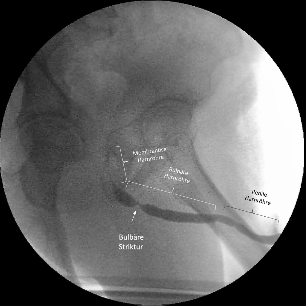 Die bulbäre Harnröhrenstriktur Urologie & Andrologie Universimed Medizin im Fokus